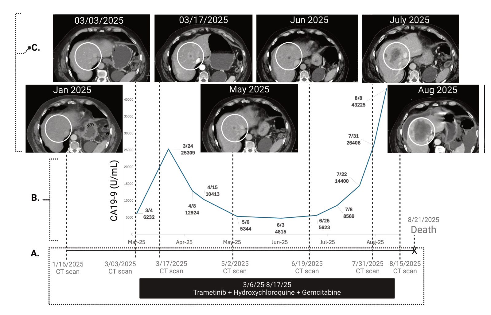 Fig. 8：Sixth-Line Therapy Achieves Durable Response in Daraxonrasib-Resistant Metastatic PDAC. 211 Patient treatment and outcome. (A) Timeline. (B) Serial CA19-9 levels on MEK inhibitor-based combination 212 therapy. (C) Serial CT scans; a representative liver lesion (white circle) is followed over time. Within the first 2-3 213 weeks, disease progressed rapidly: a new liver lesion appeared on 3/17/25 (absent on 3/3/25), with CA19-9 214 rising from 6,236 (3/4/25) to 25,309 (3/24/25). From 3/24/25, the patient responded to therapy, with decreasing 215 CA19-9 and stabilization of the liver lesion. In July, CA19-9 rose again, and by 7/31/25 CT showed significant 216 progression (4.8 months from treatment initiation), with the lesion nearly doubling in size from 7/31/25 to 8/15/25. 217