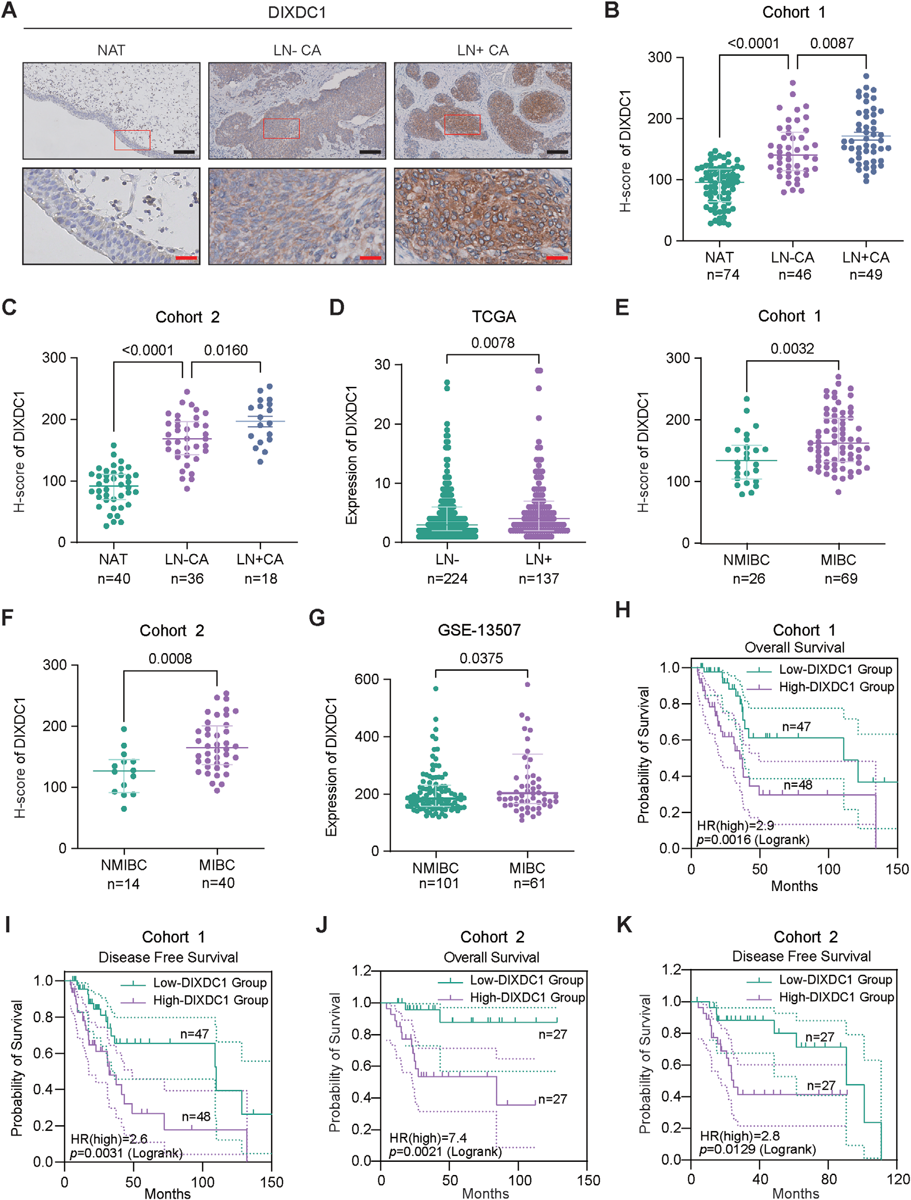 Fig. 1：DIXDC1 is overexpressed and associated with poor prognosis in bladder cancer. (A) Representative immunohistochemical (IHC) staining images showing DIXDC1 expression in adjacent normal tissues (NAT), lymph node-negative bladder cancer tissues (LN− CA), and lymph node-positive bladder cancer tissues (LN+ CA), with high-magnification images of the red-boxed regions shown below. Scale bar: 100 µm (black), 20 µm (red). (B, C) Quantitative H-score analysis of DIXDC1 protein expression in NAT, LN− CA, and LN+ CA tissues from Cohort 1 (B) at the Second Affiliated Hospital of Kunming Medical University and Cohort 2 (C) at Sun Yat-sen Memorial Hospital. (D) Analysis of DIXDC1 mRNA expression levels in lymph node-negative and lymph node-positive bladder cancer samples based on data from The Cancer Genome Atlas (TCGA). (E, F) Comparative analysis of DIXDC1 protein expression between non-muscle-invasive bladder cancer (NMIBC) and muscle-invasive bladder cancer (MIBC) tissues in Cohort 1 (E)