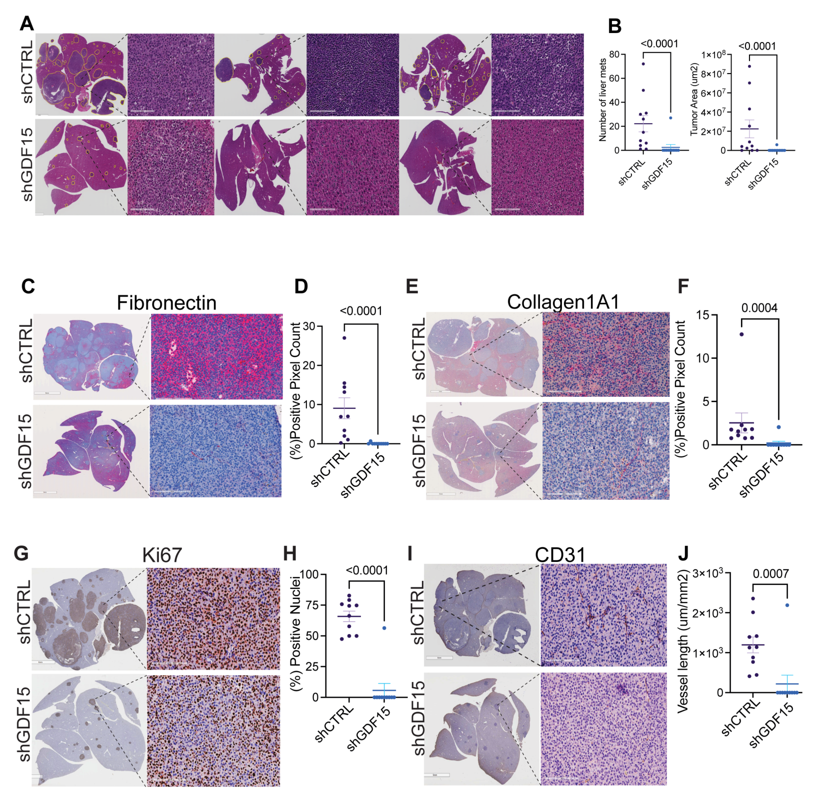 Fig. 8:Silencing of GDF15 reduces eye->liver metastasis, associated with reduced