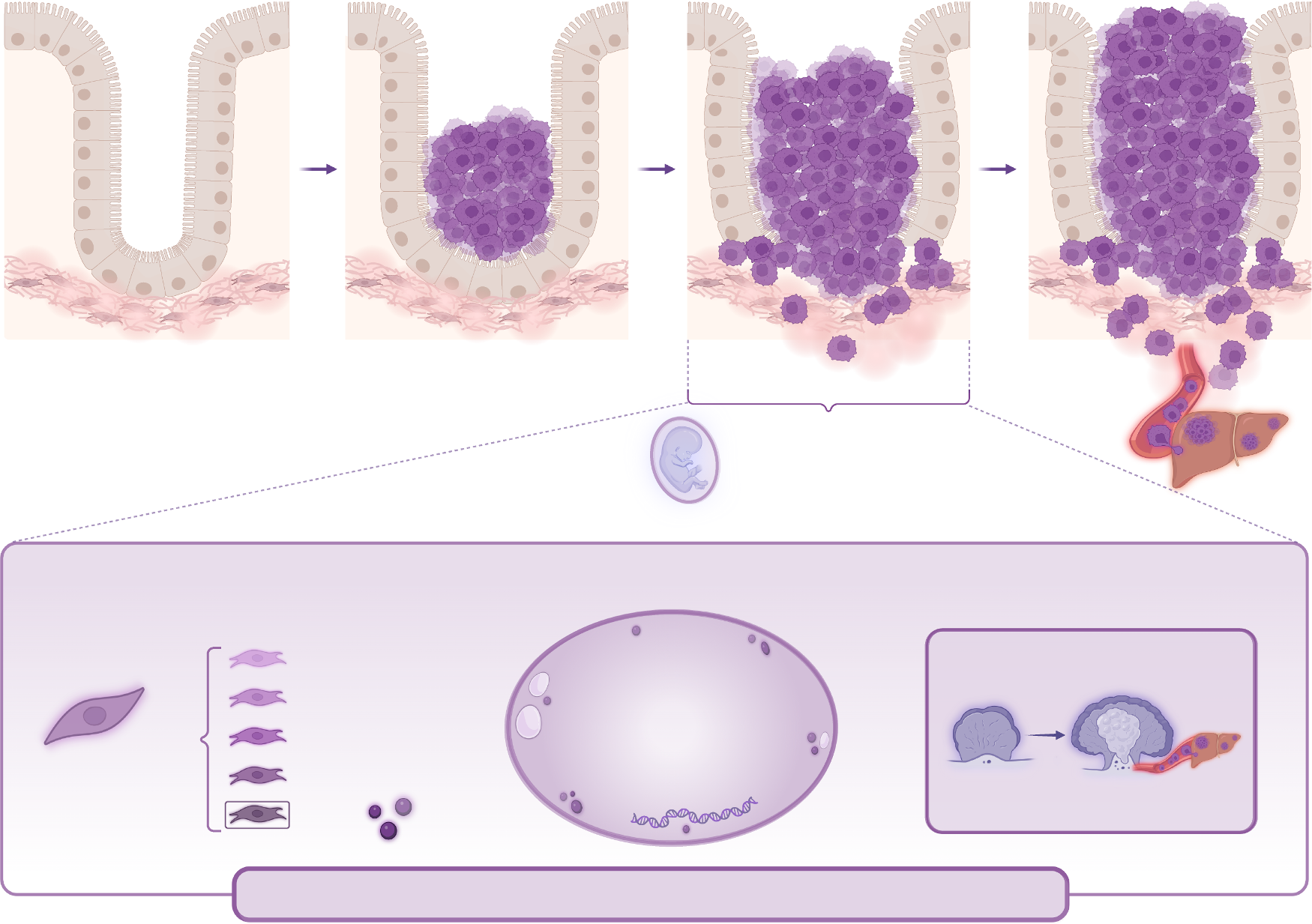 Fig. 1：Oncofetal plasticity as an early, pre-metastatic feature of colorectal cancer Schematic illustrating the emergence of oncofetal plasticity during early colorectal cancer progression. Fibroblast lineage reprogramming occurs at the invasive front of early lesions, where tumor cell interactions with cancer-associated fibroblasts (CAFs) through stromal signaling factors, including TGF-β and PGE2, promote activation of the oncofetal program. This process is associated with the induction of fetal-like gene expression signatures, including EMP1, ANXA1, LAMC2, and MMP7, as well as developmental and cellular plasticity pathways that contribute to metastatic disease progression.