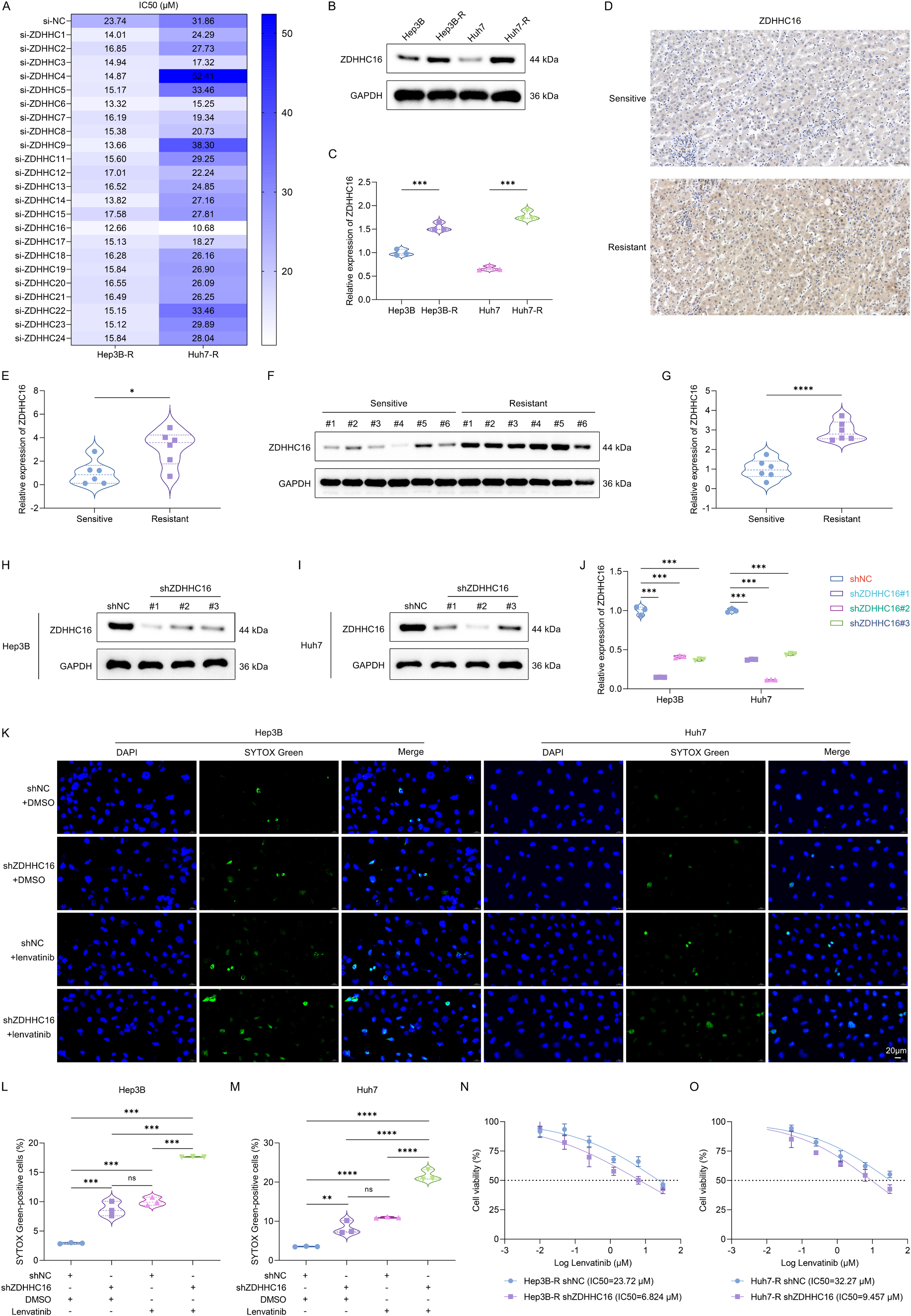 Fig. 1：ZDHHC16-mediated S-palmitoylation is crucial for regulating HCC sensitivity to lenvatinib. (A) Heatmap showing the IC50 value of lenvatinib in different groups. Hep3B-R and Huh7-R cells were transfected with specific siRNAs of 23 palmitoyl acyltransferases and corresponding controls (si-NC) for 24 h, and treated with a series of doses of lenvatinib for 24 h. Cell viability was detected through CCK−8 assay, and the IC50 value of lenvatinib was calculated. (B, C) Western blot for the expression of ZDHHC16 in lenvatinib-resistant Hep3B and Huh7 cells (Hep3B-R and Huh7-R) and their parental cells. (D, E) IHC staining for detecting the expression of ZDHHC16 in lenvatinib-sensitive and -resistant tumor tissues derived from HCC patients (n = 6 per group). Scale bar, 50 μm. (F, G) Western blot for detecting the expression of ZDHHC16 in lenvatinib-sensitive and -resistant tumor tissues derived from HCC patients (n = 6 per group). (H-J) Western blot for the expression of ZDHHC16 in Hep3B and Huh7 cells that were transfected with three ZDHHC16 shRNAs (shZDHHC16#1, #2, #3) and corresponding controls (shNC) for 48 h. (K-M) SYTOX Green for analyzing the dead cells in Hep3B and Huh7 cells that were transfected with shZDHHC16 or shNC for 48 h and treated with 10 μM lenvatinib or DMSO for 24 h. Scale bar, 20 μm. (N, O) The IC50 value of lenvatinib in lenvatinib-resistant HCC cells. Hep3B-R and Huh7-R cells were transfected with shZDHHC16 or shNC for 48 h, followed by treatment with a series of lenvatinib doses for 24 h. After measuring cell viability using CCK−8 assay, the IC50 value of lenvatinib was calculated. , P < 0.05; , P < 0.01; , P < 0.001; , P < 0.0001; ns, P > 0.05 from Student’s t test or one-way ANOVA followed by Tukey’s post hoc test.