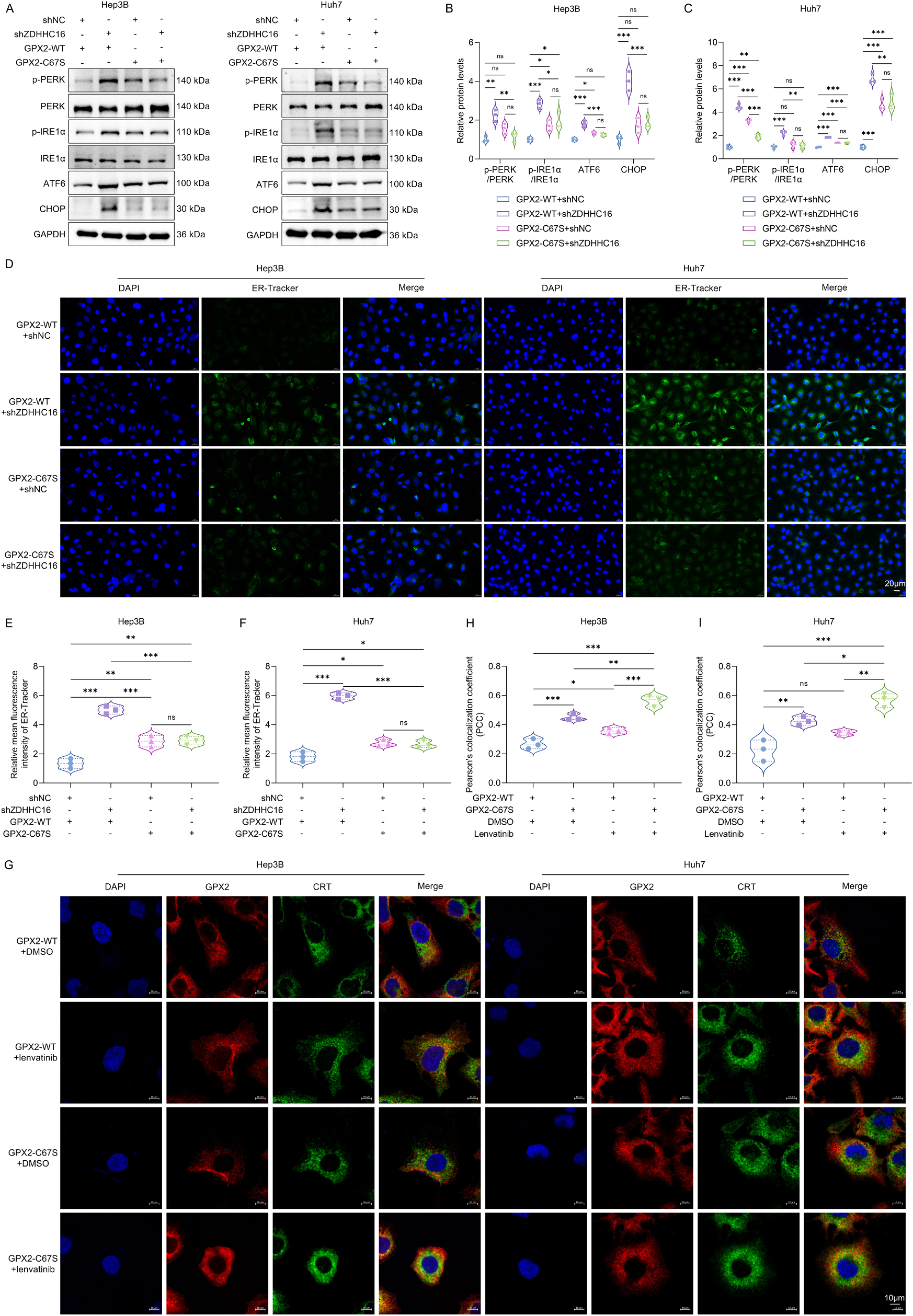 Fig. 7：ZDHHC16 inhibits lenvatinib-induced ER stress in HCC cells by catalyzing the S-palmitoylation of GPX2. (A-C) Western blot for measuring the expression levels of phosphorylated PERK and IRE1α as well as ATF6 and CHOP in Hep3B and Huh7 cells that were co-transfected with shZDHHC16/shNC and GPX2-WT/GPX2- C67S as well as treated with DMSO or lenvatinib (10 μM). (D-F) ER-Tracker Green fluorescent probe staining for evaluation of ER stress in HCC cells that were co- transfected with shZDHHC16/shNC and GPX2-WT/GPX2-C67S as well as treated with DMSO or lenvatinib (10 μM). Scale bar, 20 μm. (G) IF confocal microscopy showing the colocalization of GPX2 and CRT in HCC cells that were transfected with GPX2-WT/GPX2-C67S and treated with DMSO or lenvatinib (10 μM). Scale bar, 10 μm. (H, I) Quantification of Pearson’s colocalization coefficient (PCC) of GPX2 and CRT. , P < 0.05; , P < 0.01; , P < 0.001; ns, P > 0.05 from one-way ANOVA followed by Tukey’s post hoc test.
