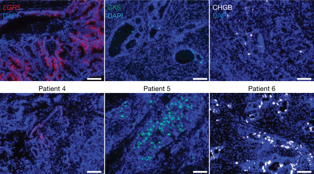 Fig. 3：Loss of ZFP36L2 inhibits CRC metastasis seeding and ISC dedifferentiation but promotes non-canonical differentiation. a–c, Orthotopic caecal xenotransplantation experiments. a, Schematic of the experiment. DOX, doxycycline. b, In vivo abdominal BLI average radiance, normalized to BLI at the time of doxycycline diet initiation. shL2, shZFP36L2. n (left to right) = 8, 5, 7, 8, 8, 14, 10 and 7 animals per group. Mean ± s.e.m.; two- tailed Mann–Whitney U-tests. c, End point ex vivo BLI of MSK107Li samples. Metastasis signals were normalized to orthotopic caecal signals in the same animals. n = 10 (shCtrl) and 7 (shL2) mice. Mean ± s.e.m.; two-tailed Mann– Whitney U-tests. d–g, Orthotopic liver metastasis seeding experiments. d, Schematic of the experiment. e, Representative ex vivo images of MSK107Li liver metastases. f, Average radiance of week 13 metastasis normalized to week 0 BLI. n = 6 (shCtrl) and 5 (shL2) mice. Mean ± s.e.m.; two-tailed Mann–Whitney U-tests. g, Weekly whole-body in vivo liver BLI (mean ± s.e.m.) normalized to week 0. n = 7 (shCtrl) and 5 (shL2) mice. Two-tailed Mann–Whitney U-tests. h, Schematic of the experiment. i. Kernel density estimate contour plots of scRNA-seq data from h, showing the overlap and divergence of cell states in OKG146P organoids transduced with shCtrl or shL2 and cultured in HISC, IGFF